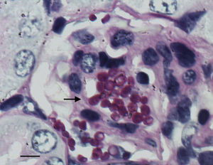 Presence of fungal infiltration (black arrow) in the kidney section of a control mouse infected with C. guilliermondii, at 8 days post infection (periodic acid Schiff staining, magnification 1000×). Bar=10μm.
