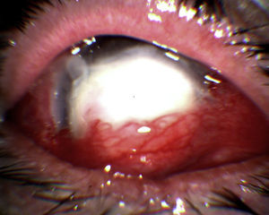 Úlcera corneal grave con recubrimiento conjuntival.