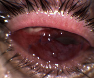 Aspecto de la úlcera corneal tras el segundo recubrimiento conjuntival y terapia con voriconazol.