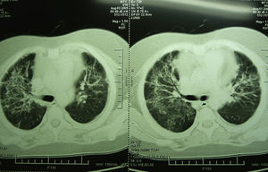 CT scan: diffuse bilateral intersticial inflitrate, more evident in the right lung, is shown, as well as left pleural effusion of 16 mm. Regular diffuse septa thickening, areas of mild ground-glass attenuation and pericardial effusion are also shown.