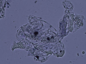 Hifas parcial o totalmente huecas, con áreas ausentes de protoplasma, observadas por examen directo de un paciente afectado de onicomicosis (KOH, 40×).