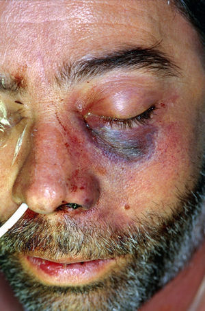 Lesión cutánea necrótica secundaria a mucormicosis angioinvasiva órbito-cerebral en un paciente diabético.