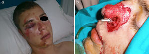 Mucormicosis diseminada de inicio rinosinusal en un paciente con traumatismo craneofacial. (a) Día 1 del trauma. (b) Día 26 postrauma. Perforación del tabique nasal (flecha).