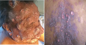 Clinical images of the patient showing reddish-violaceous nodules and tumors with scales on face and scalp (left). Ill-defined violaceous plaques with ulcerations on the back (right).