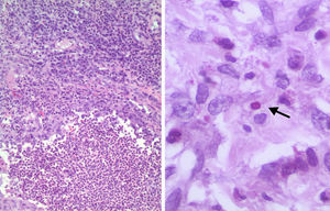 Suppurative granuloma with central microabscesses composed of neutrophils surrounded by epithelioid cells, and a peripheral zone infiltrated by lymphoid and plasma cells (hematoxylin-eosin stain, 100×) (left). An oval body (4μm in diameter) with a lighter center and darker stain at the periphery is seen, suggestive of Sporothrix yeast (PAS stain, 400×) (right).