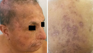 Clinical pictures of the patient after being treated with itraconazole. The improvement is evident, although hyper and hypopigmented areas with atrophic scars remained on the affected areas.