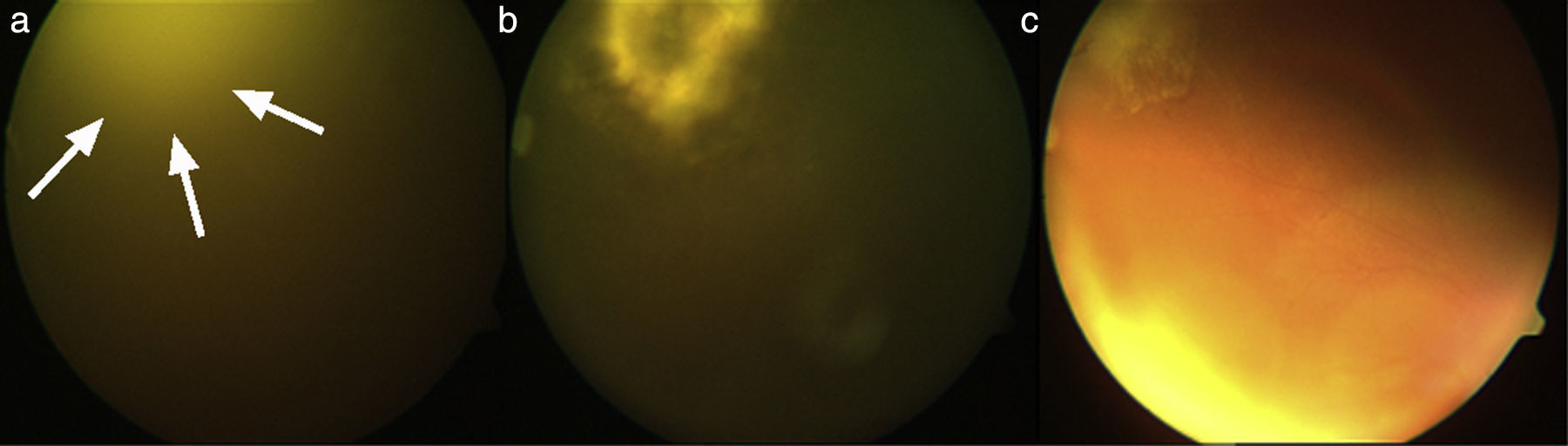 Disseminated fusariosis and hematologic malignancies, a still devastating  association. Report of three new cases | Revista Iberoamericana de Micología