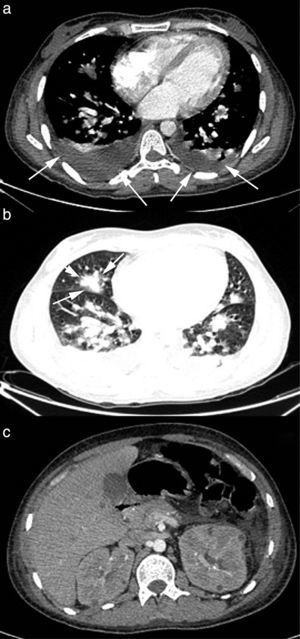 CT scan images of patient 2 infected with Fusarium solani species complex. Bilateral pleural effusion (panel a, arrows) and multiple pulmonary nodules, some of them with an incipient “halo sign” (panel b, arrows). Renal and liver microabscesses (panel c).