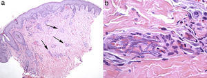 Skin biopsy of patient 2. (a) Low power image of skin biopsy showing patchy inflammatory infiltrates in the dermis, and (b) high power image of a cutaneous artery showing intraluminal accumulations of Fusarium solani species complex hyphae.