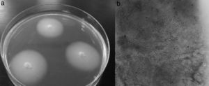Fusarium dimerum strain isolated from patient 3. (a) Culture on Sabouraud agar, and (b) microscopic observation of a cutaneous biopsy treated with KOH.