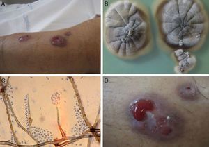 A. Lesión nodular en la pierna izquierda. B. Colonia del hongo en agar glucosado de Sabouraud tras 20 días de incubación a 30°C. C. Conidiogénesis (x1.000). D. Úlcera fistulada.