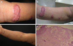 (a), (b) Case 1: patient's right upper extremity showing characteristic lymphocutaneous spread of infection with granulomatous appearance. (c) Complete resolution of the lesion. (d) Histological section (HE-stain, 100×).