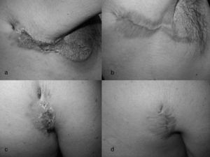 (a) Verrucous plaque (Initial); (b) after treatment; (c) Fistulae and ulcerative lesion (initial); (d) after treatment.