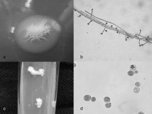 (a) Blastomyces dermatitidis, filamentous culture in Sabouraud dextrose agar 28°C, 25 days; (b) Sessile microconidia and microconidia emerging from short conidiophores (“lollipop-like”); (c) B. dermatitidis, yeast culture in Sabouraud dextrose agar, 37°C, 5 days; (d) yeasts with thick base.