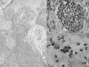 (a) Histopathology, tuberculoid granuloma (H&E, ×10). (b) Microabscess with blastoconidia (H&E, ×100). (c) Blastoconidia with thick base (Giemsa, ×100).
