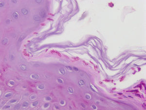 Hifas y esporas en el estrato córneo. Tinción PAS (×40).