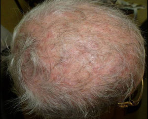 Tinea capitis in a postmenopausal woman with systemic lupus erythematosus treated with immunosuppressive drugs. Scarring alopecia and secondary infection due to T. tonsurans were diagnosed.