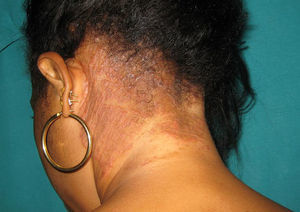 Tinea capitis in a HIV-positive premenopausal woman from Senegal.