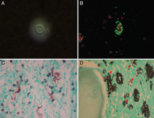Fungal agents. (A) India ink preparation of cerebrospinal fluid showing an encapsulated yeast-like Cryptococcus neoformans (1000x). (B) Direct immunofluorescence in induced sputum showing the honeycombed-structures consistent with Pneumocystis jirovecii (400x). (C) Gomori-Grocott silver stain in induced sputum showing small fungal cells consistent with Histoplasma capsulatum (400x). (D) Bone marrow histopathology showing yeasts consistent with Histoplasma capsulatum (arrows) and Cryptococcus neoformans (Gomori-Grocott silver stain, 400x).