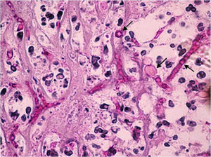 PAS stained section of the enucleated ocular tissue. Irregular, thin, septate hyphae and round fungal structures (arrows) with a background of necrotic detritus and neutrophils were observed (40×).