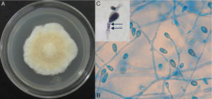 Macroscopic and microscopic morphology of the causative Scedosporium boydii. (A) A colony grown on potato dextrose agar is shown. (B) Microculture mount in lactophenol blue showing numerous annelloconidia (100×). (C) Close-up of the conidium and annellide showing rings (arrows) after conidiation is shown (40×, plus zoom 4).