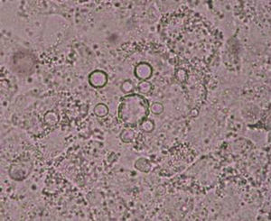 Examen microscópico directo en fresco que muestra células esféricas con pared de doble contorno y blastoconidios (×400).