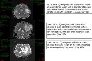 Brain MRIs on days 83 and 130 and 496.