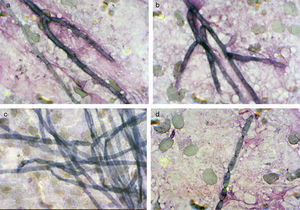 Scarcely separated hyphae (a–c) and intact conidial chains (d) with conidiogenous scars seen in Giemsa-stained abscess and imprinted tissue slides.