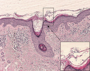 Epidermis de características normales con presencia de hifas y esporas en la capa cornea (tinción con hematoxilina-eosina ×10). A mayor detalle, y en la esquina inferior derecha de la imagen, puede apreciarse lo que se denomina «espaguetis y albo¿ndigas», que corresponden respectivamente a las hifas y esporas de Malassezia (hematoxilina-eosina ×40).