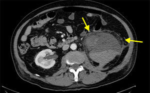 Hematoma en la celda renal izquierda con mala diferenciación de la corteza renal (probablemente por rotura), que se extiende por la región perirrenal y de manera adyacente al músculo psoas.