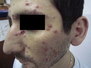 Paciente con lesiones cutáneas papulocostrosas en el rostro.