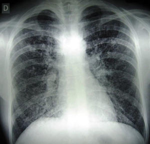 Radiografía de tórax donde se observan imágenes intersticiales y micronodulillares.