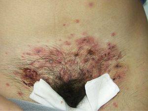 Pápulo-pústulas y costras melicéricas localizadas en el pubis.