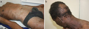 (a) Exfoliative erythroderma. (b) Diffuse non-scarring and circumscribed alopecia.