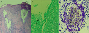 (a) Follicular inflammation with rupture of the adnexal. (b) Presence of fungal elements – PAS stain. (c) Follicular stem parasitized by hyphae – PAS stain.