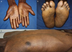 (a, b) Complete regression of palmoplantar hyperkeratosis. (c) Complete regression of exfoliative erythroderma.