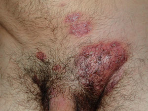 Erythematous tumefaction of the groin with pustules and bald areas.