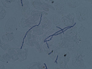 Multiple hyphae observed on direct microscopy (KOH, 400×).