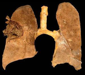 Pieza de necropsia (corte macroscópico coronal). En los lóbulos superior derecho y medio se observa una cavidad llena de coágulos de sangre en medio de amplias áreas de destrucción tisular.