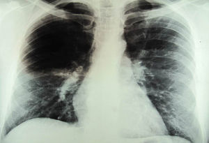 A chest X-ray revealing diffuse infiltrates that were predominantly located at the base of the right lung and perihilar nodules.