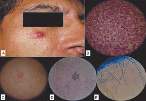 (A) The patient with an erythematous nodule. (B) A biopsy of a skin sample, with Coccidioides spp. spherules stained with periodic acid-Schiff. (C and D) Spherules present in the nodule. (E) Direct examination of the culture, revealing the presence of Coccidioides mycelium with arthroconidia.