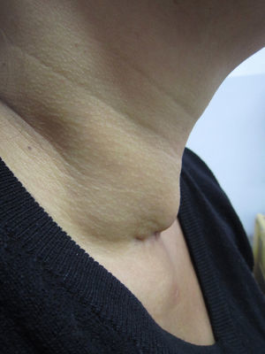 Nódulo en cara anterior de cuello, de perfil.