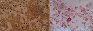Microfotografías de la biopsia del nódulo coloreadas con Grocott (A) y mucicarmín (B) donde se observan elementos levaduriformes capsulados.
