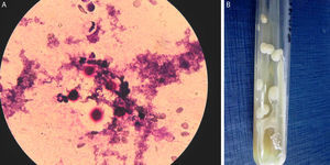 Coloración de Giemsa de la lesión fistulosa donde se observan levaduras con halo claro (A) y el cultivo del agente causal obtenido de esa lesión (B).