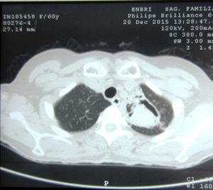TAC de tórax donde se observa una cavidad en el lóbulo superior derecho.