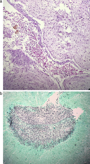 (a) Abundant PAS-positive structures compatible with fungal infection in the lumen of a dilated bile duct (40×). (b) Conglomerate of positive fungal structures destroying the adjacent liver parenchyma revealed using Grocott-Gomori methenamine silver stain (40×).