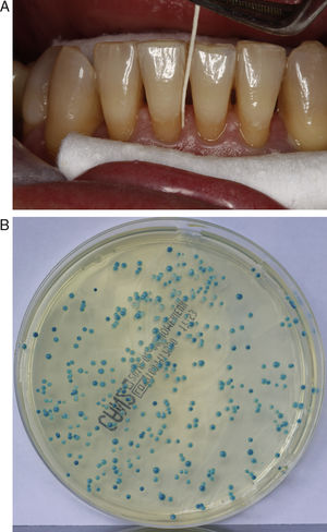 (A) Oral microbiological sampling of the periodontal pocket of a lower incisor using a sterile paper point. (B) Candida growth in Candida chromogenic agar.