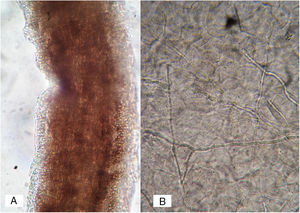 (A) Direct examination with KOH 10% of a hair with ectothrix parasitism (case 1); (B) multiple filaments in the scales (case 2).