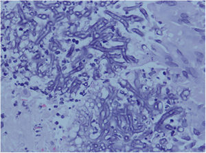 Biopsia cutánea. Tinción con hematoxilina-eosina que muestra hifas tabicadas compatibles con Scedosporium apiospermum.