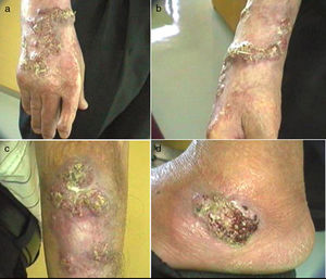 Vegetative lesions on the hand (a), forearm (b), elbow (c) and left foot (d).